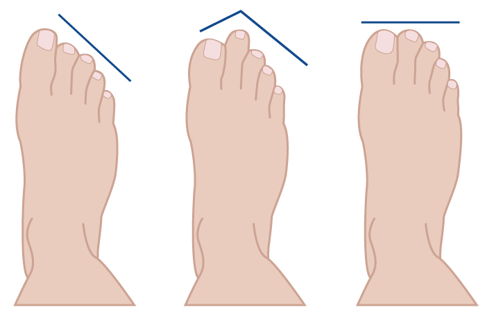 qu'est-ce qu'un hallux valgus