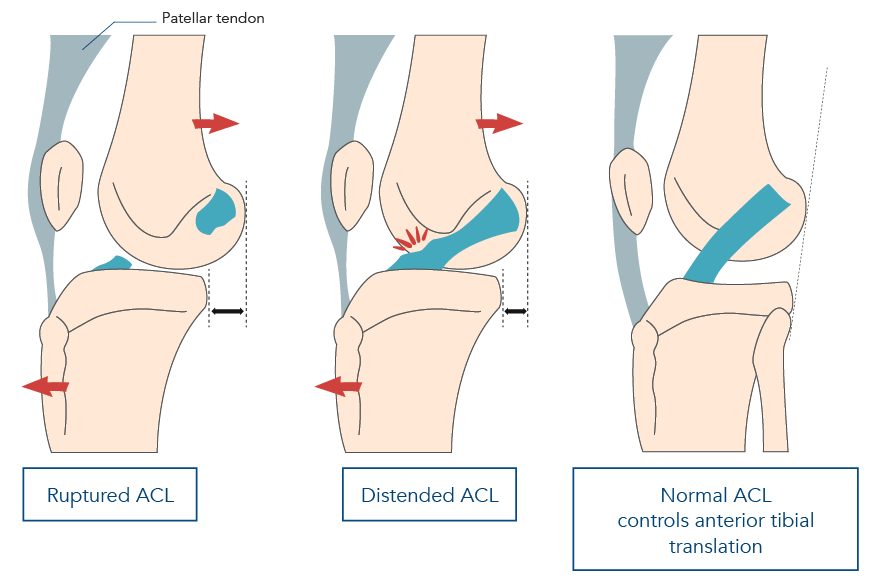 anterior crucial ligament